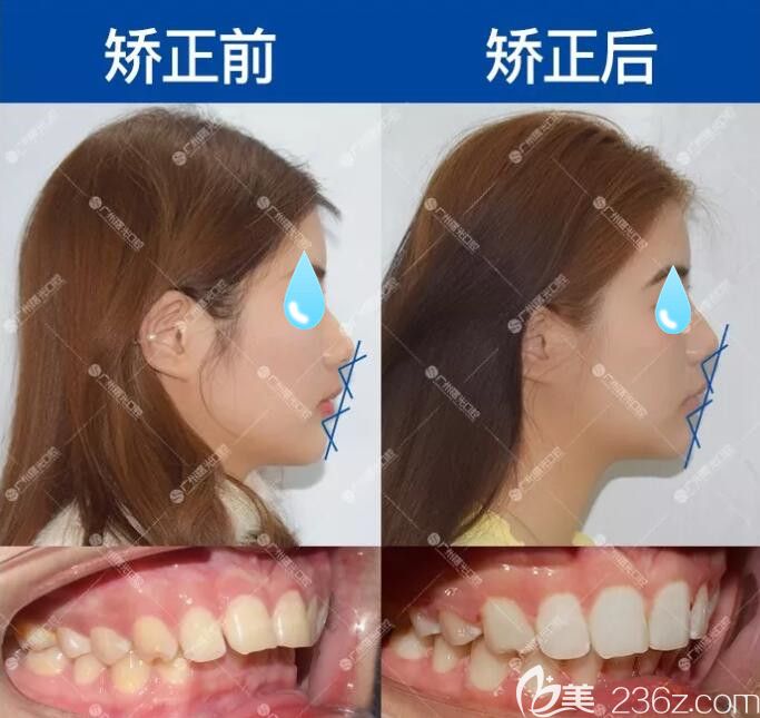 深覆合矯正前后臉型對(duì)比圖和口內(nèi)對(duì)比照
