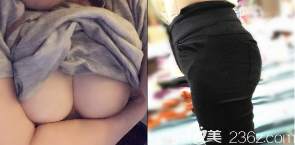 說我脂肪量充足腰腹吸脂后我選擇自體脂肪豐胸和自體脂肪豐臀一起做