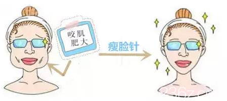 咬肌肥大的人注射瘦臉的樣子