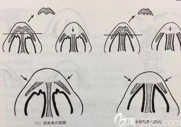 截骨法改善駝峰鼻手術原理