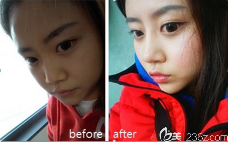 分享我在jk做鼻子的經(jīng)歷比較滿(mǎn)意很自然