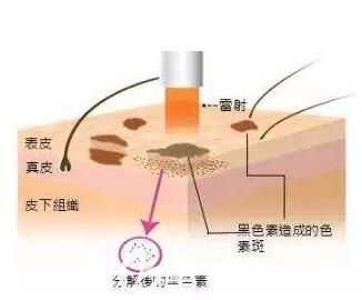 激光祛斑原理介紹