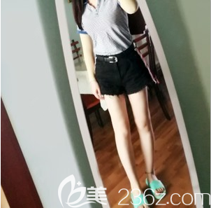 看成都趙善軍很多吸脂案例都很安心，就做了大腿環(huán)吸+膝蓋內(nèi)側(cè)吸脂+臀線塑形