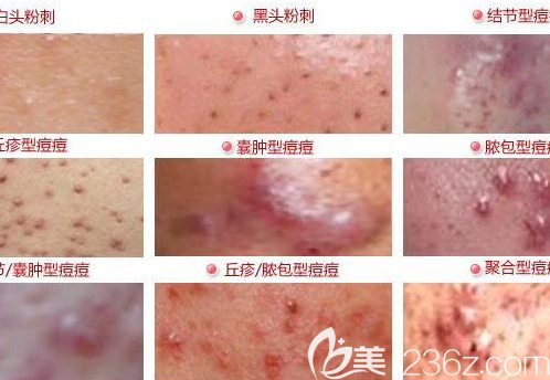 痘痘的種類及具體類型示意圖