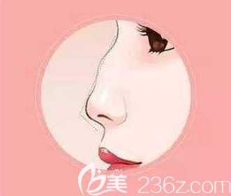 駝峰鼻的形成原因