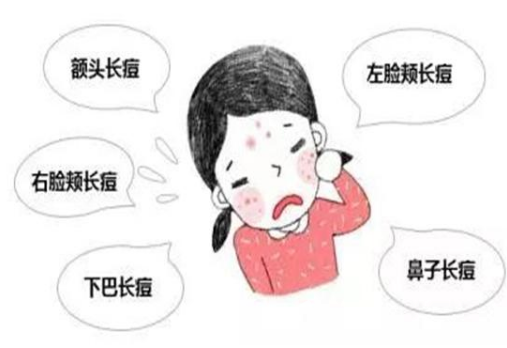 臉上長(zhǎng)痘痘怎么調(diào)理