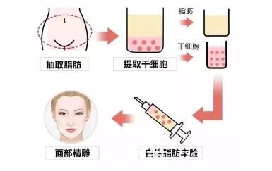 自體脂肪填充淚溝圖解