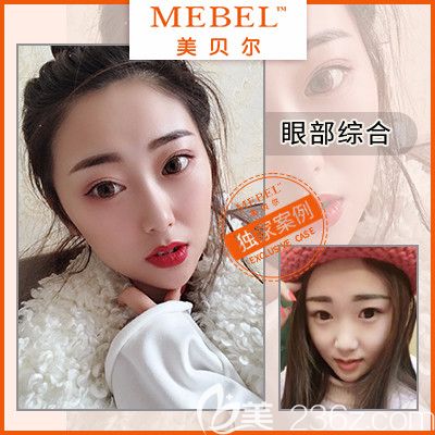 蘇州美貝爾眼綜合案例 蘇州美貝爾眼綜合案例