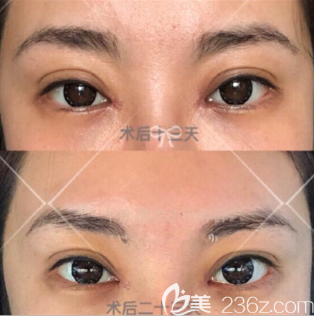 韓國eve鄭潤載眼角修復(fù)好嗎 韓國eve鄭潤載眼角修復(fù)好嗎