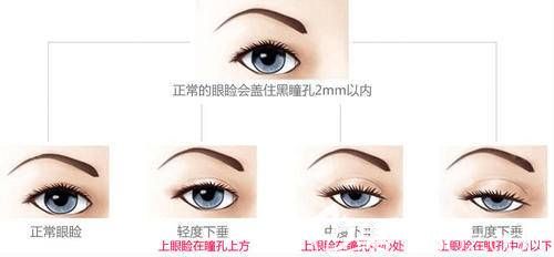 不同程度的上瞼下垂出現(xiàn)的情況