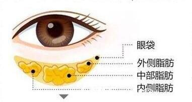 眼袋形成的原因