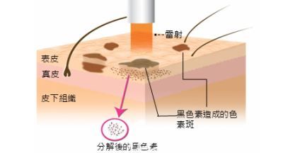 紅寶石點(diǎn)陣激光術(shù)后無色沉問題