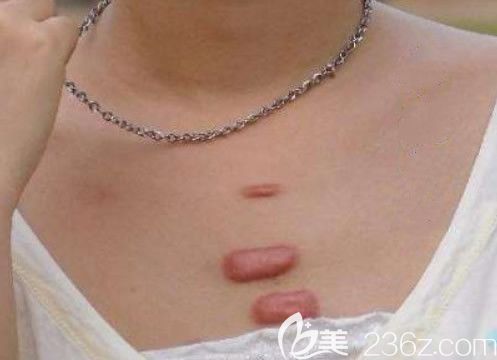 胸前疤痕疙瘩圖片