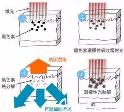 激光祛斑原理介紹