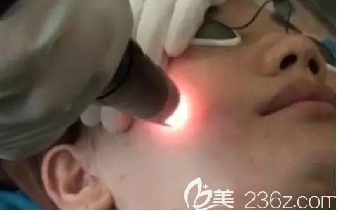 激光祛斑手術(shù)過程真人效果圖