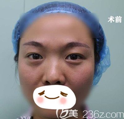 在漯河締美儷做膨體隆鼻前 在漯河締美儷做膨體隆鼻前