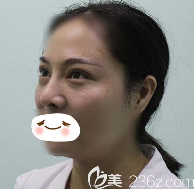 在漯河締美儷做膨體隆鼻2周后 在漯河締美儷做膨體隆鼻2周后