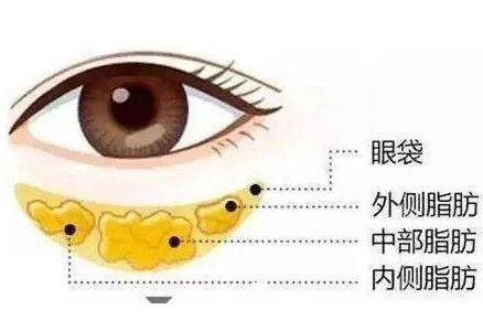 韓式手術(shù)去眼袋效果怎么樣？好不好？