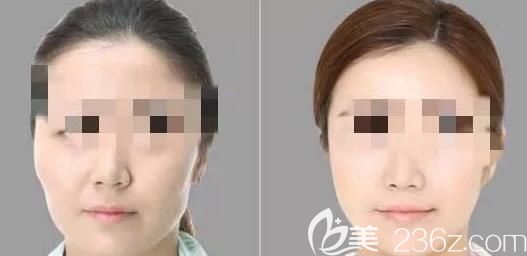 顴骨內(nèi)推手術(shù)案例