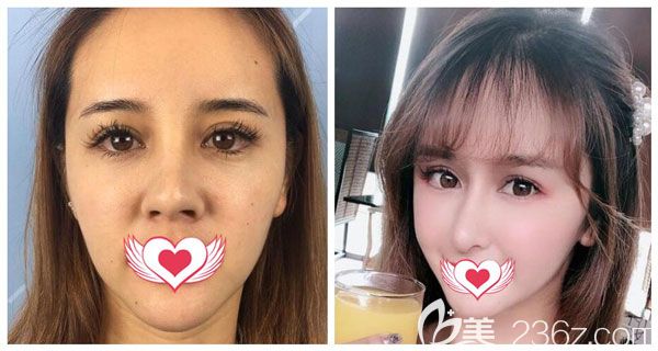做隆鼻失敗修復(fù)案例效果對比圖