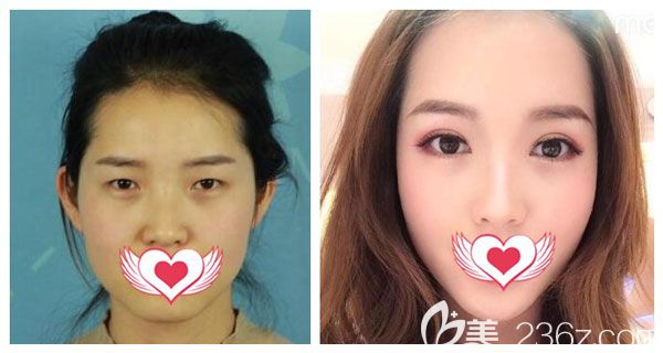 胡凱做眼綜合+全切雙眼皮+提肌+去脂案例效果