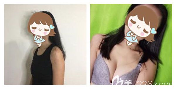 做曼托假體隆胸案例效果對比圖