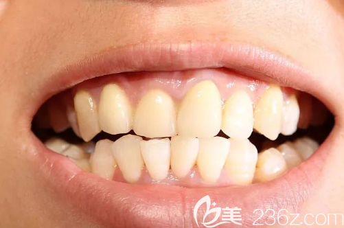 牙齒清潔健康非常重要