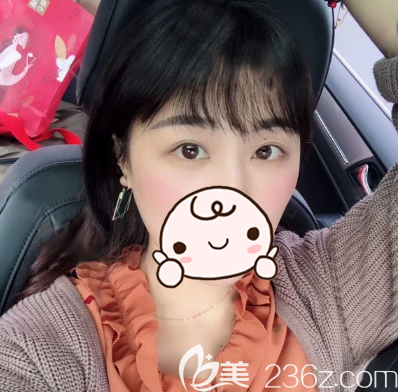 找王家勇做了大腿吸脂術(shù)后效果理想就又做了內(nèi)切祛眼袋