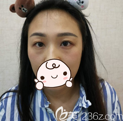 去眼袋手術(shù)前的素顏照片 去眼袋手術(shù)前的素顏照片