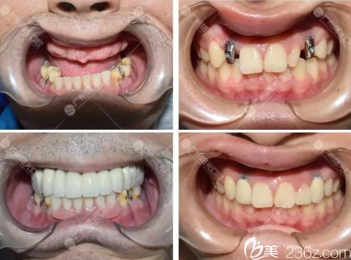 他們都通過在曙光口腔做種植牙，重獲新牙