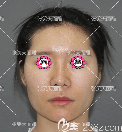 我找北京圣嘉新張笑天做顴骨和下頜角整形前樣子