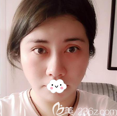 <!--<i data=20240703-sp></i>-->鐘正強(qiáng)中下面部線雕術(shù)后效果圖 <!--<i data=20240703-sp></i>-->鐘正強(qiáng)中下面部線雕術(shù)后效果圖