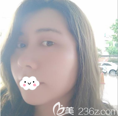 鐘正強建議我做面部埋線提升成功解決了臉大雙下巴難題