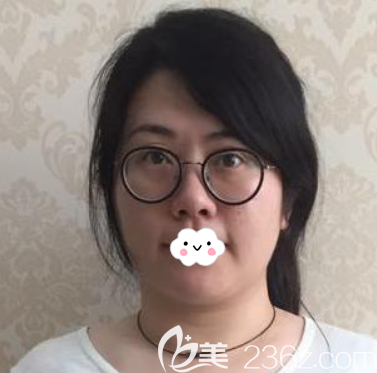 面部埋線提升術(shù)前照片 面部埋線提升術(shù)前照片