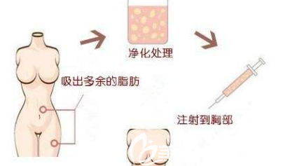 自體脂肪隆胸示意圖