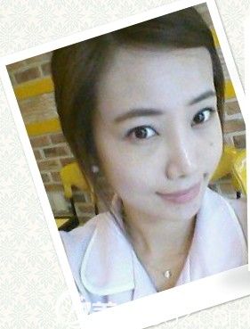 韓國那木MMPRP脂肪移植后感覺自己精神了很多填了眼下方+八字紋+臉部