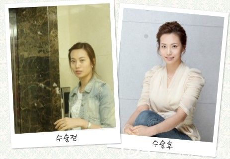 韓國那木MMPRP脂肪移植 韓國那木MMPRP脂肪移植