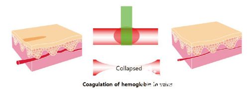 激光去紅血絲的治療原理圖