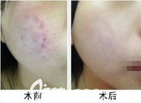激光祛痘印效果怎么樣？真人前后效果對比照