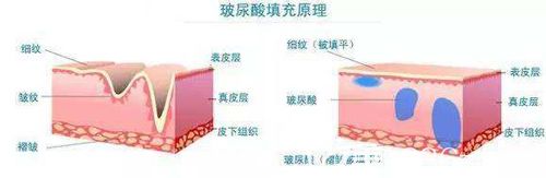 注射玻尿酸祛皺的手術原理治療過程