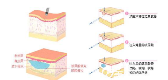 注射玻尿酸的示意圖