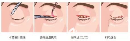 雙眼皮手術(shù)過程