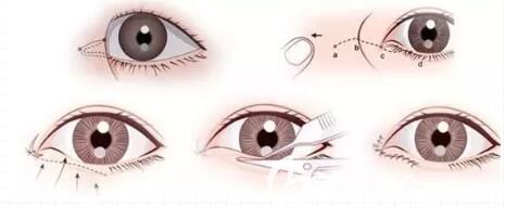 開眼角手術(shù)過程
