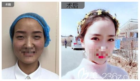 愛尚整形李冉院長眼綜合真人案例