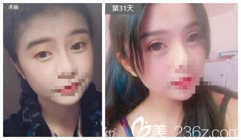 愛尚整形李冉院長眼綜合真人案例