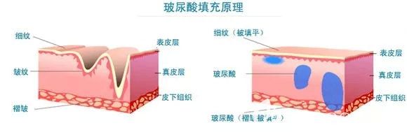 玻尿酸抗衰原理介紹