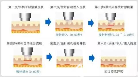 黃金射頻微針的作用原理及優(yōu)勢(shì)