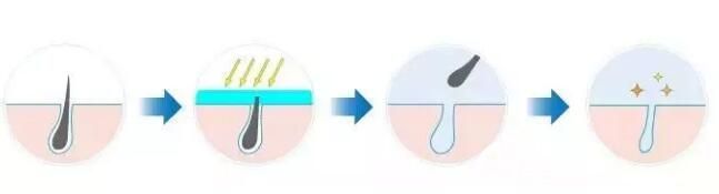 激光脫腋毛手術(shù)原理