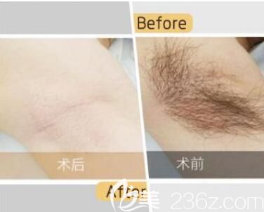 分享激光脫腋毛對(duì)比案例
