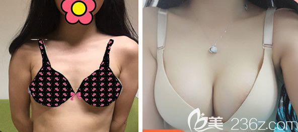 曼托275CC圓形假體隆胸效果案例 曼托275CC圓形假體隆胸效果案例